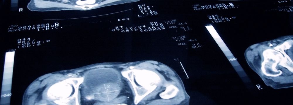 Xray showing prostate cancer on screen